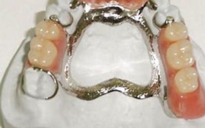 Metal dentures